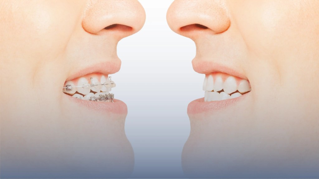 a side by side comparison of braces and no braces