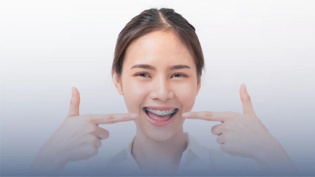 A woman showing off her traditional braces